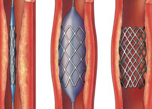 好消息！700元冠脈支架來了帶量采購結(jié)果在甘肅省正式落地執(zhí)行